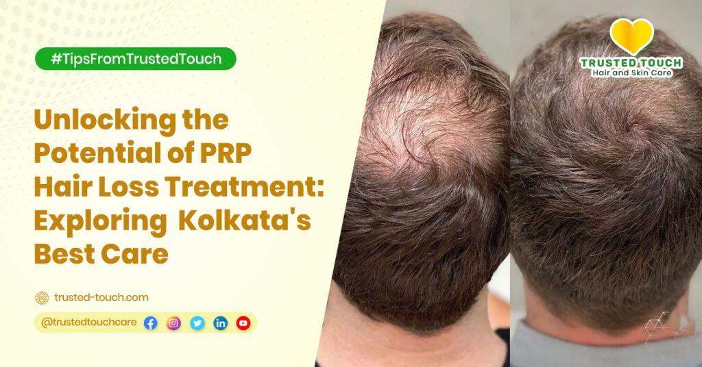 Unlocking the Potential of PRP Hair Loss Treatment: Exploring Kolkata’s Best Care<