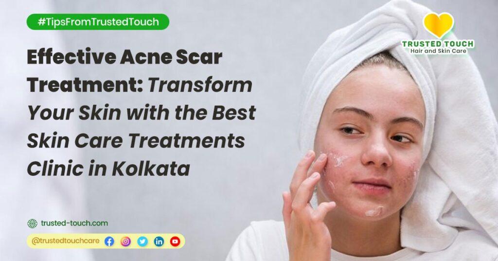 Effective Acne Scar Treatment: Transform Your Skin with the Best Skin Care Treatments Clinic in Kolkata<