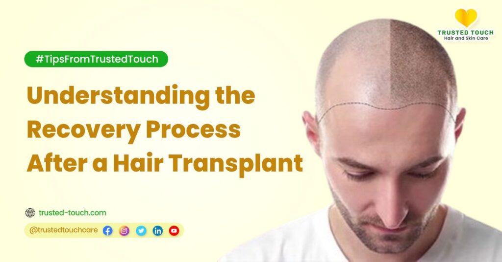 Understanding the Recovery Process After a Hair Transplant<