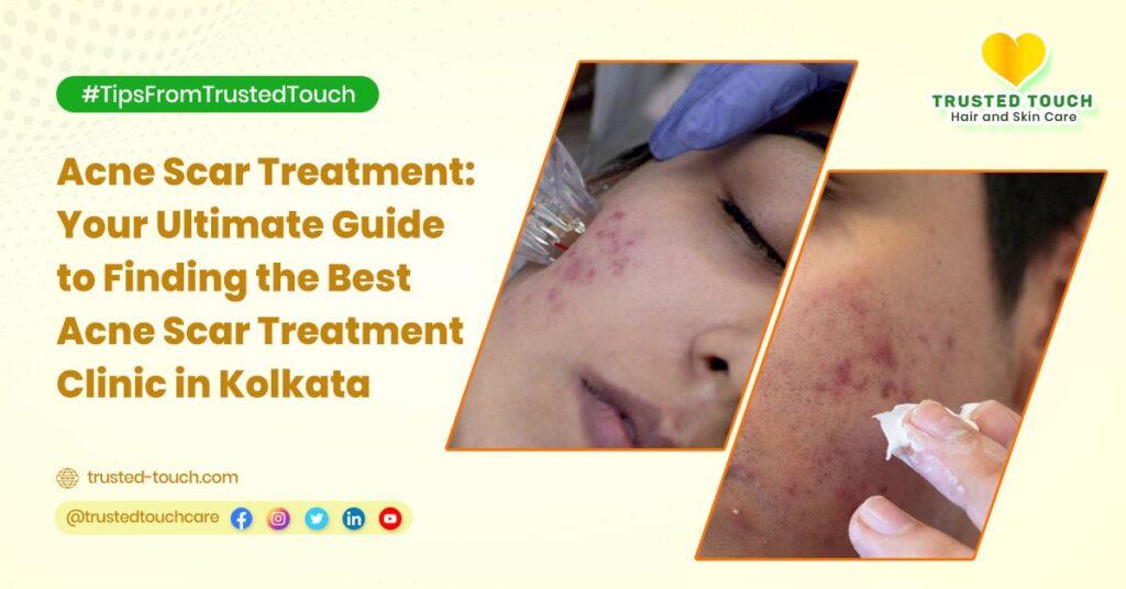 Acne Scar Treatment: Your Ultimate Guide to Finding the Best Acne Scar Treatment Clinic in Kolkata<