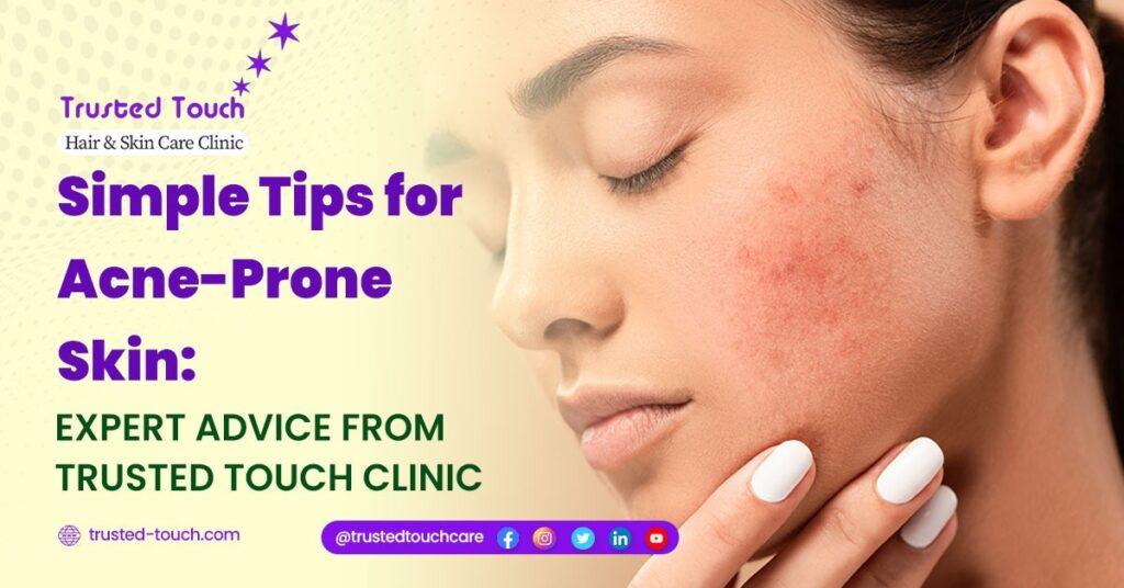 Simple Tips for Acne-Prone Skin: Expert Advice from Trusted Touch Clinic<