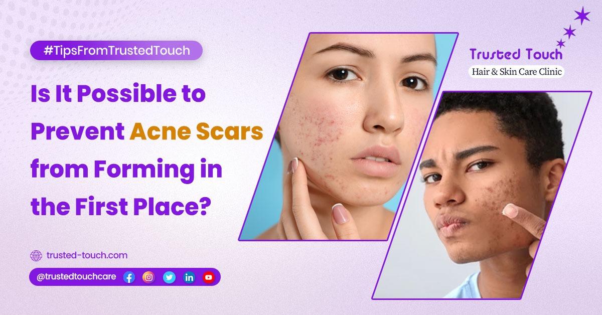 Is It Possible to Prevent Acne Scars from Forming in the First Place?